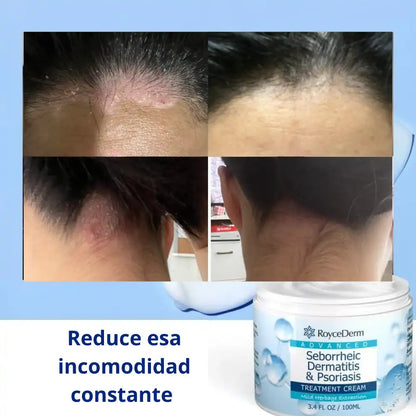 Crema para la dermatitis seborreica y la psoriasis